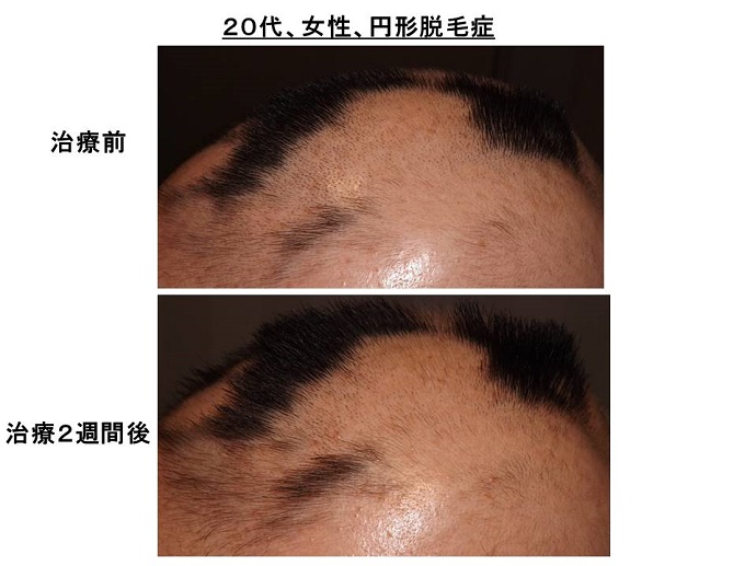 円形脱毛症　病院""